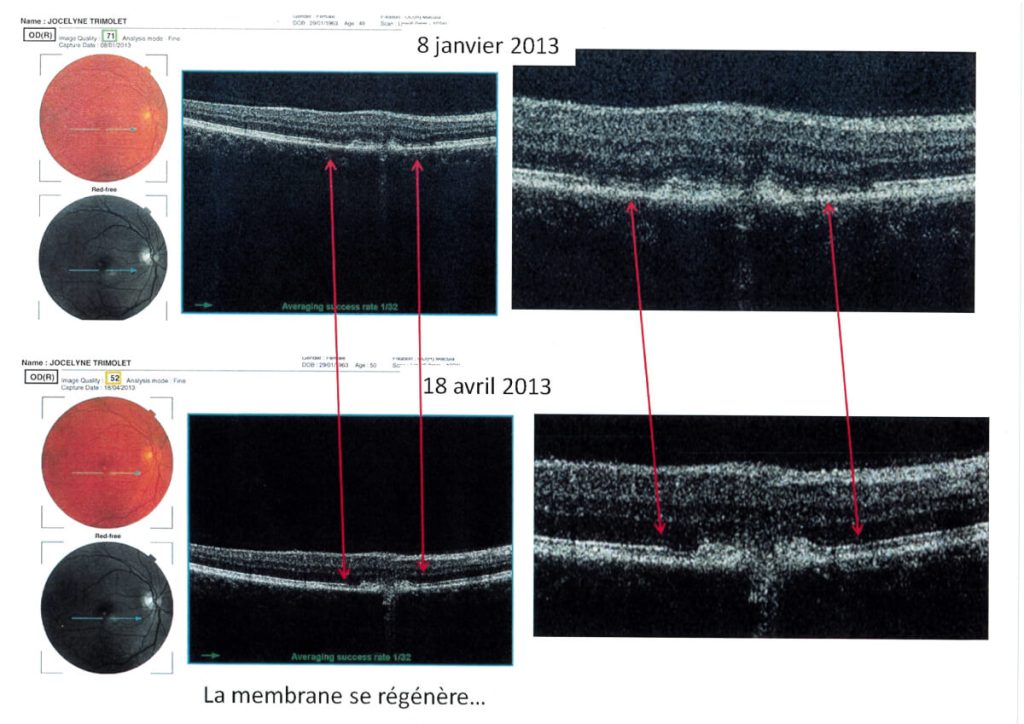 Scan de guérison de DMLA humide hémorragique fulgurante (dégénérescence maculaire liée à l'âge)