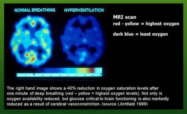 Scan de cerveau sous hyperventilation.