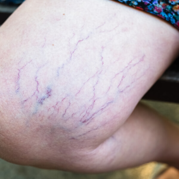 Gros plan sur des varices sur un genou, un des symptômes d'une mauvaise circulation du sang.