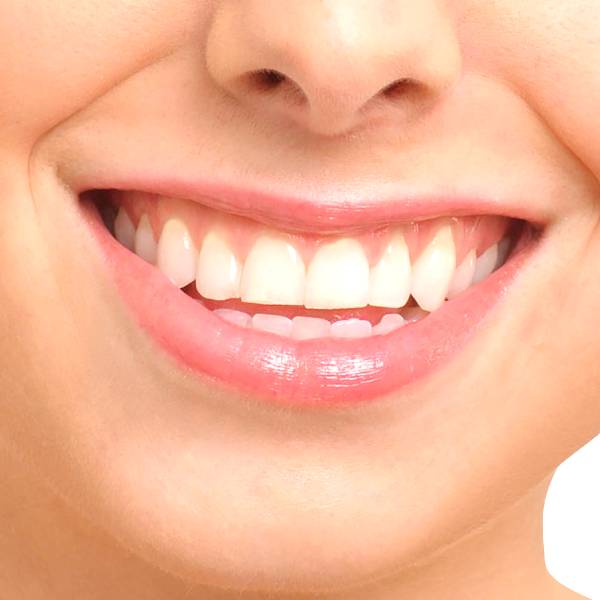 Gros plan sur un sourire remineralisation dentaire.